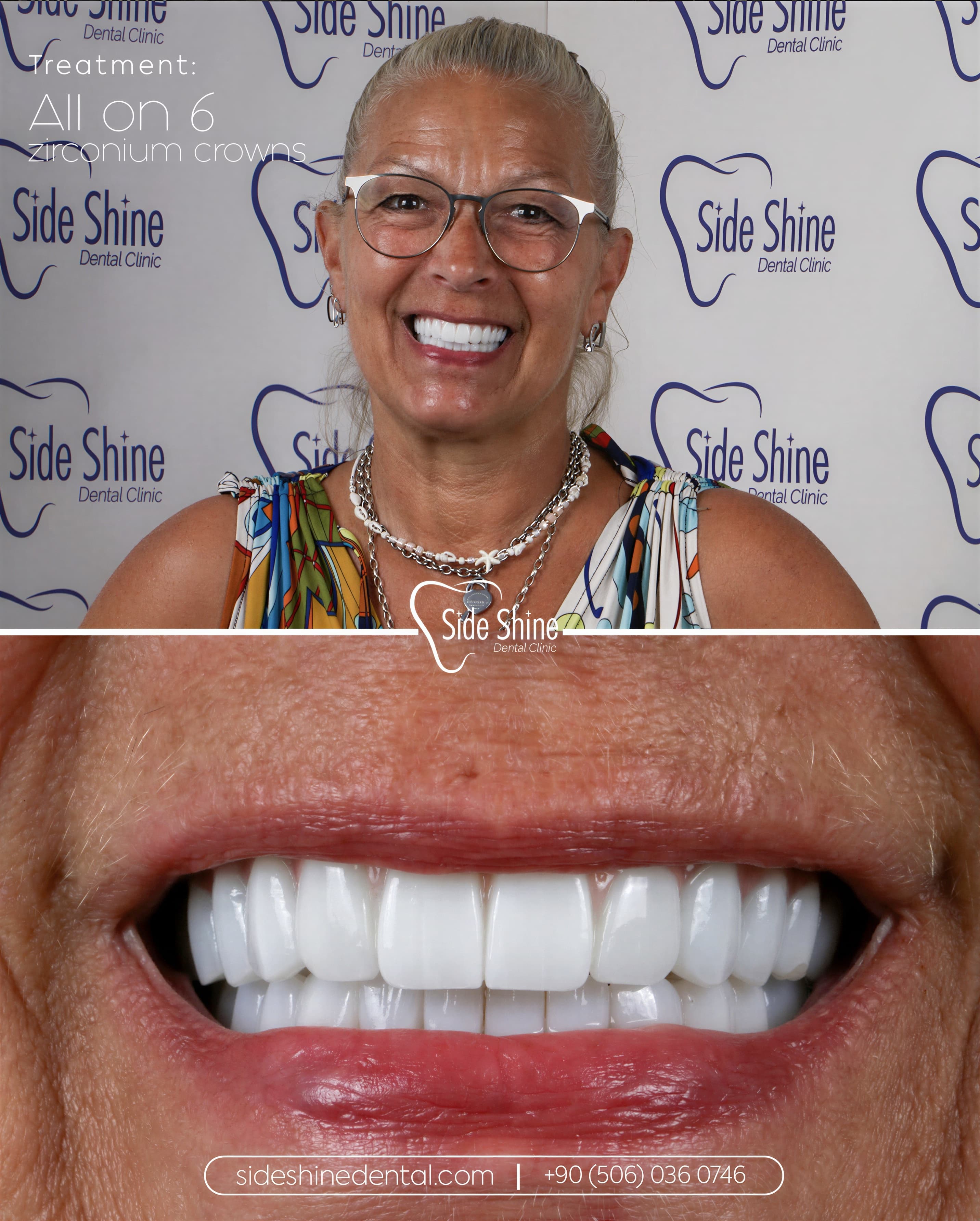 All-on-6 Behandlungsergebnis 1