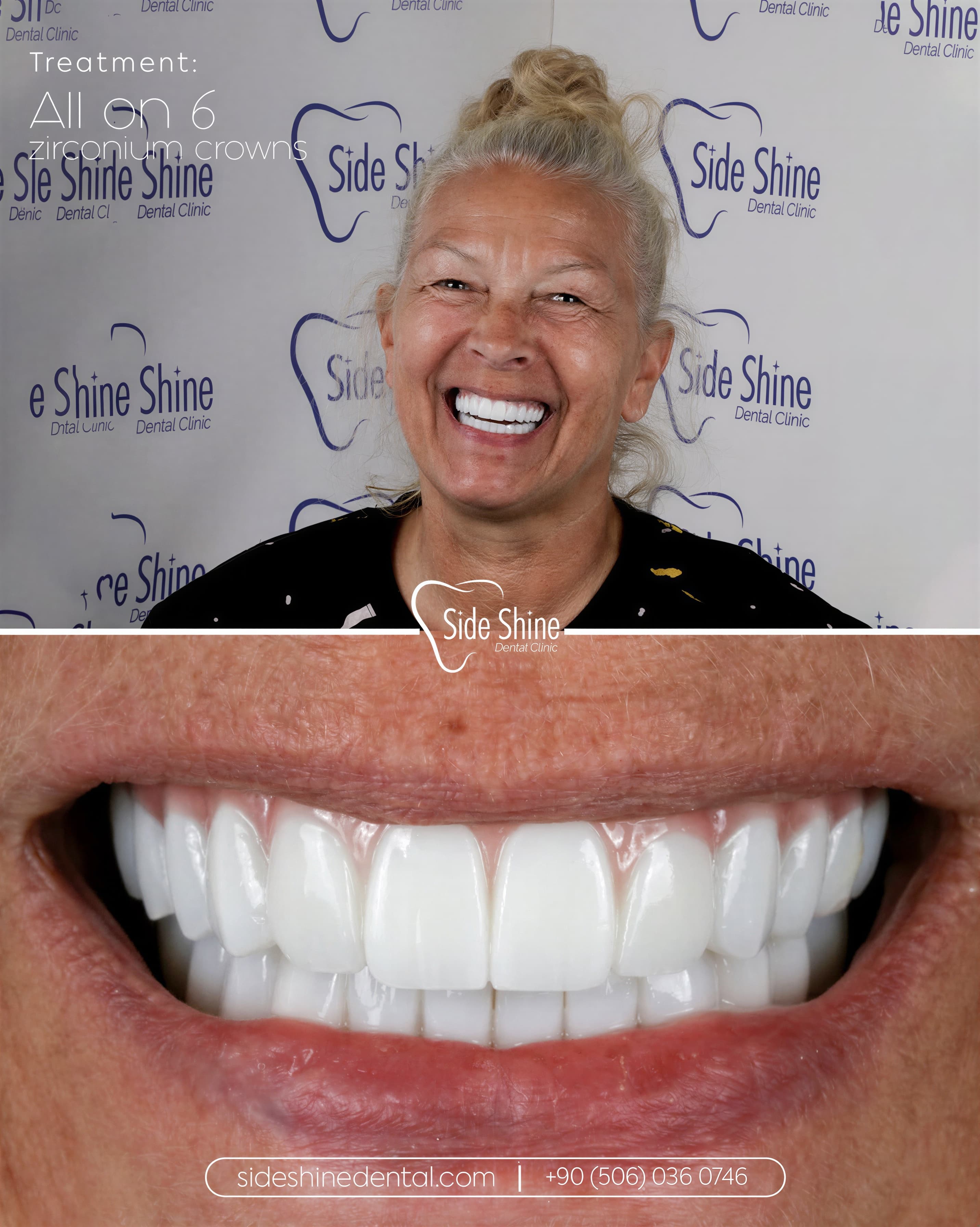 All-on-6 Behandlungsergebnis 2