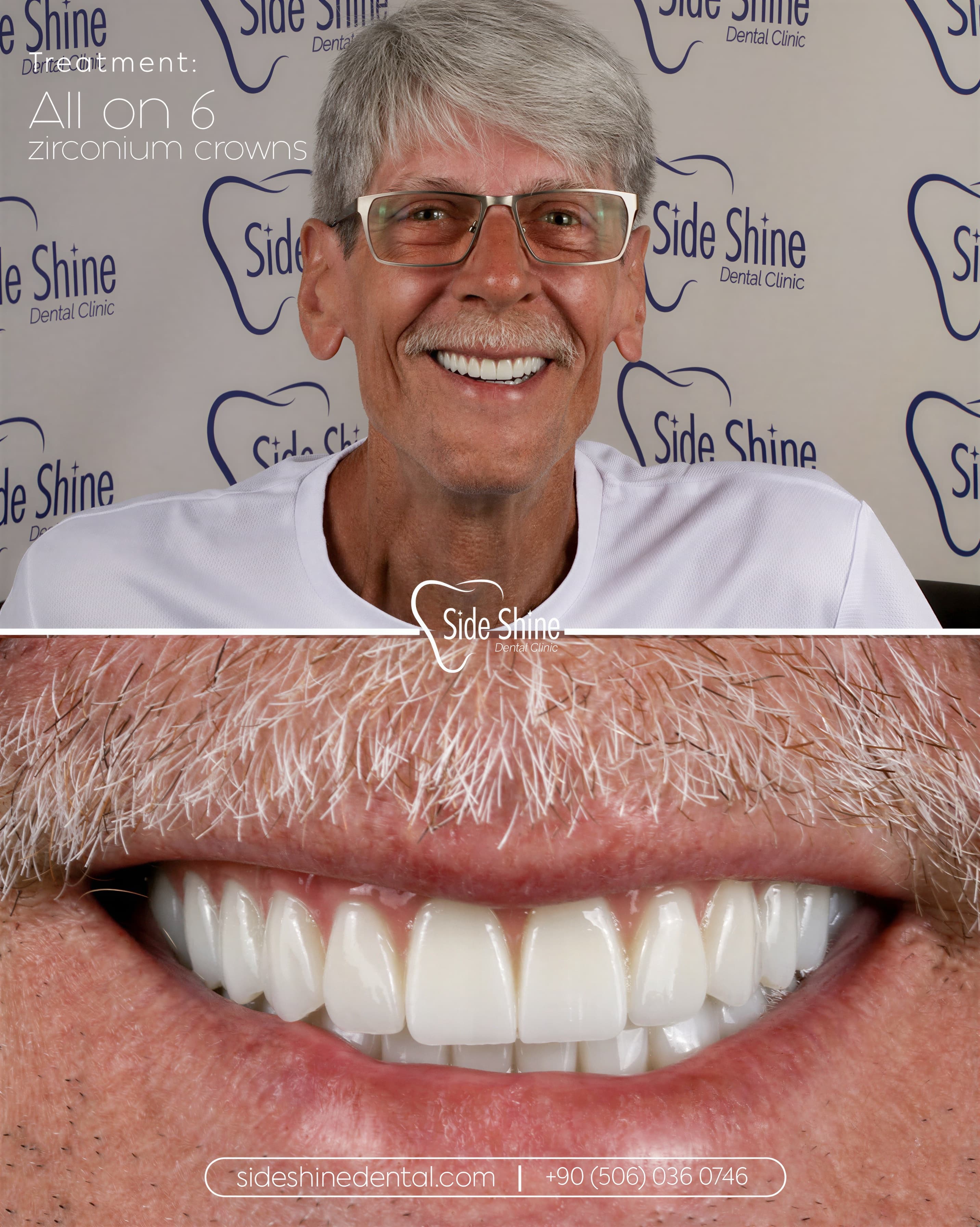 All-on-6 Behandlungsergebnis 3