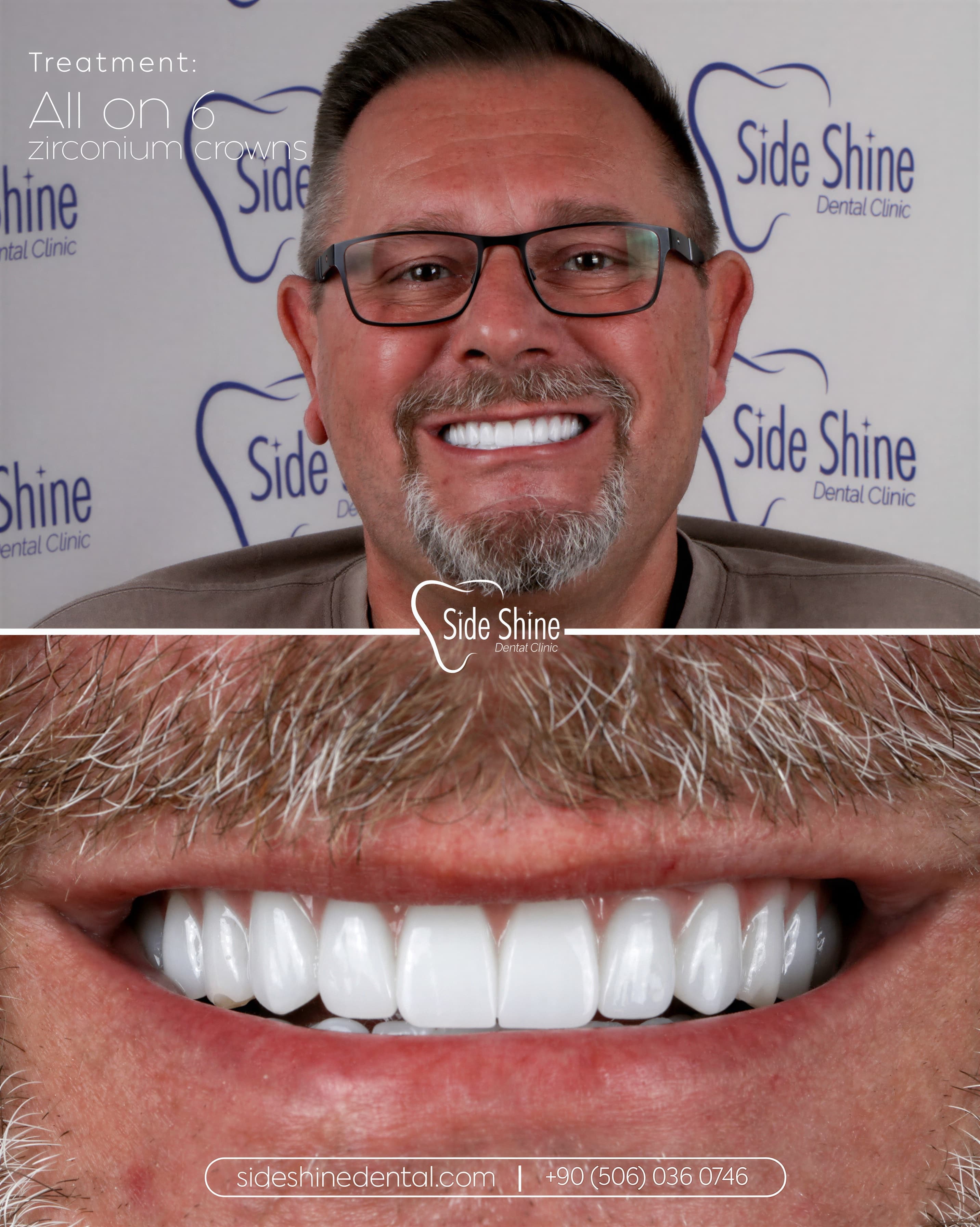 All-on-6 Behandlungsergebnis 4