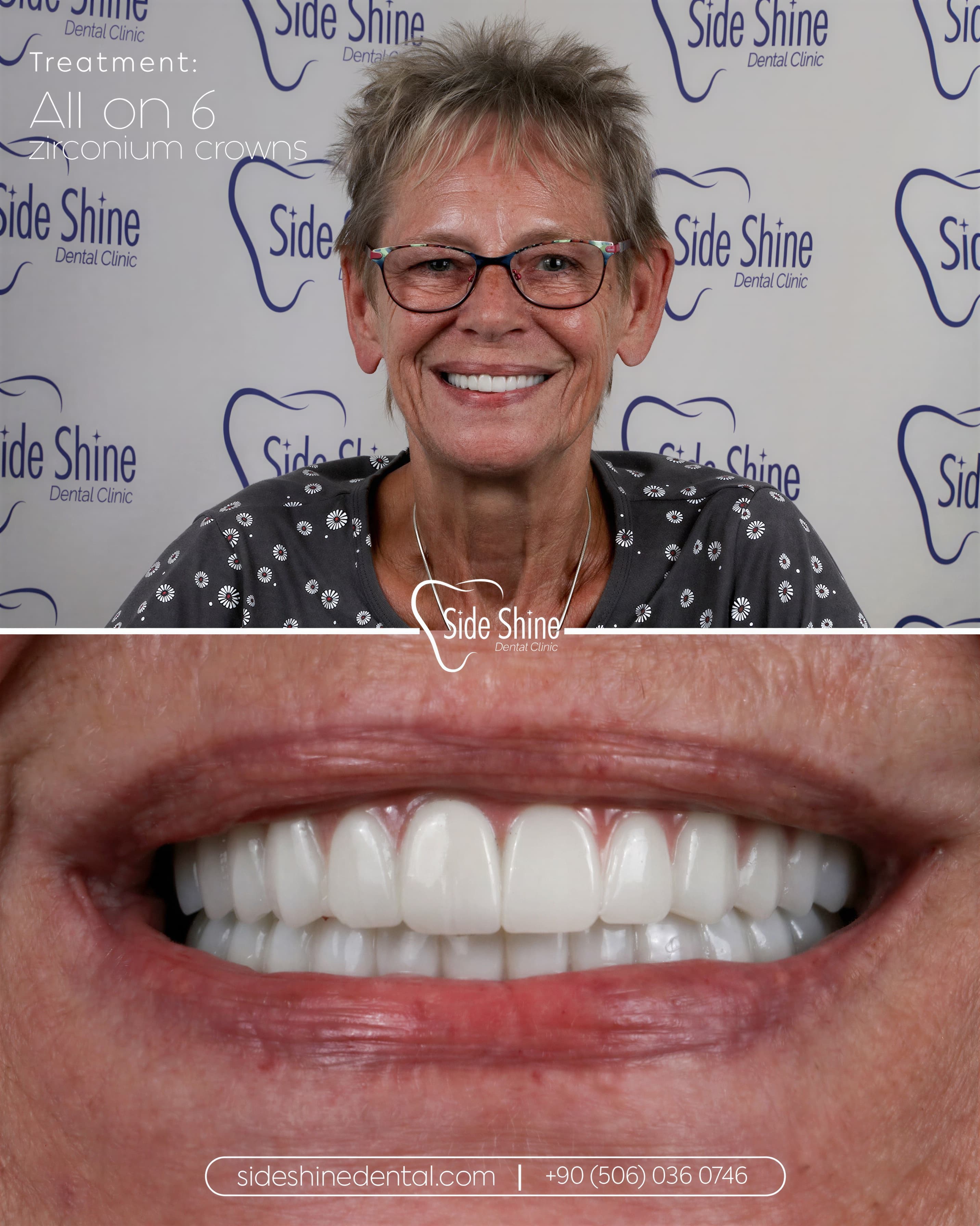 All-on-6 Behandlungsergebnis 5